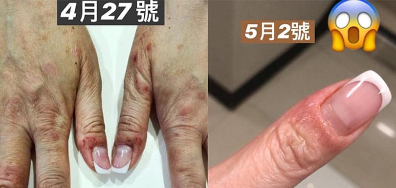 劉小慧用蛋黃油醫濕疹！ 中醫教路：蛋黃油製成膏狀可放半年