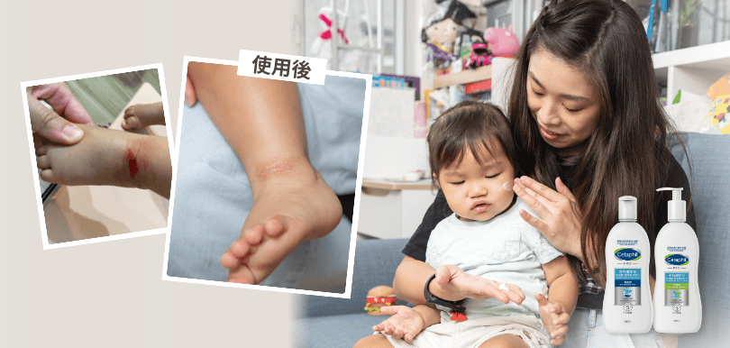 【BB濕疹】女兒皮膚滲出血水！媽媽不靠類固醇1招舒緩濕疹肌