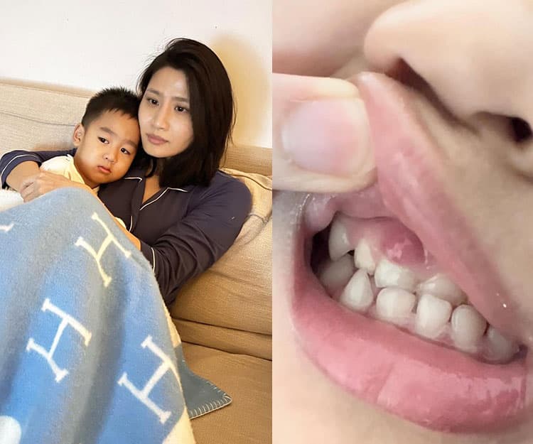 Coffee林芊妤仔仔嘴腫似鴨嘴 原來一個壞習慣引起