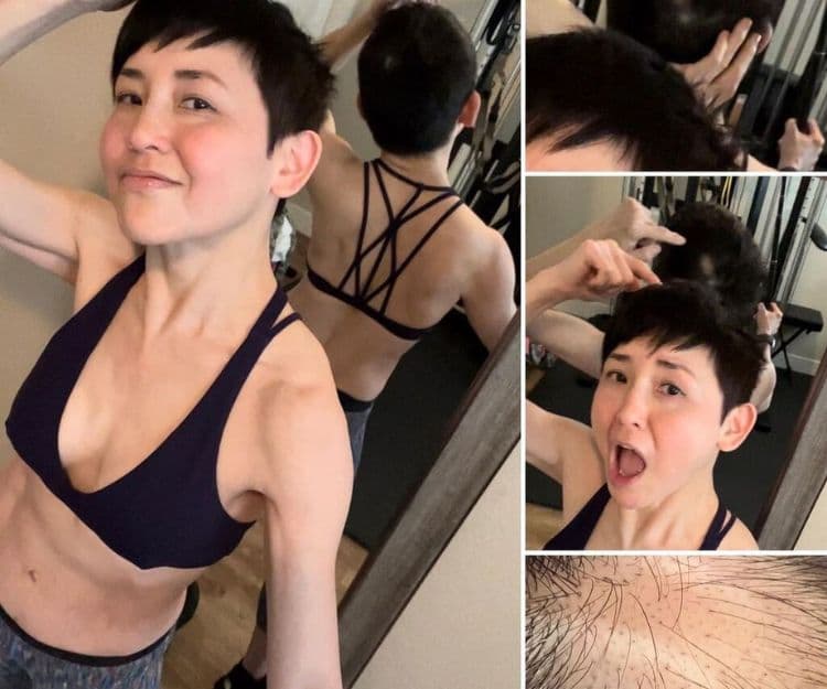 57歲最型嫲嫲劉美君驚現鬼剃頭  手指咁長！正接受治療：有一天可能掉光所有頭髮