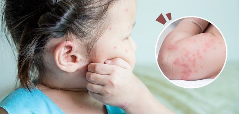 春天BB易患蕁麻疹?嚴重恐影響呼吸!兒科醫生教改善方法