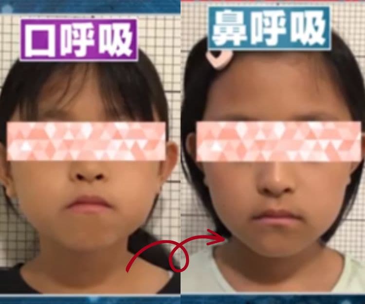 口罩後遺症|戴口罩常用口呼吸會變馬面?日本醫生教1招還原靚靚臉型
