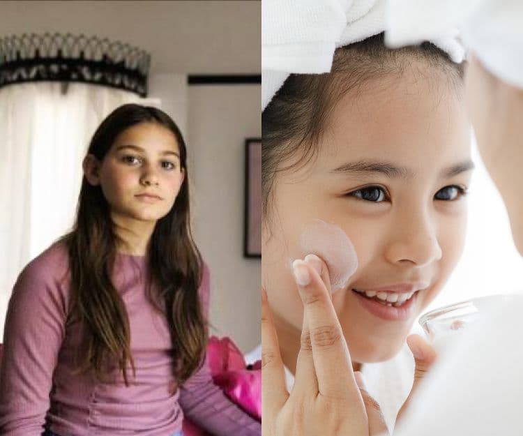 兒童護膚|10歲女童貪靚惹出禍!「過度」護膚恐永久留疤 醫生叮囑忌用2類成分 兒童臉部只需3種產品