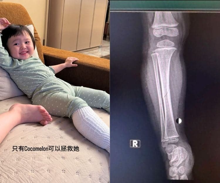 李璨琛2歲女Sucy右腳離奇嚴重骨裂 媽媽心痛:隻腳差少少就斷!骨裂=骨折?小朋友骨折3大徵兆+處理方法