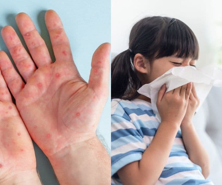 手足口病又爆發?原因、症狀全攻略!家長必收藏4個預防tips