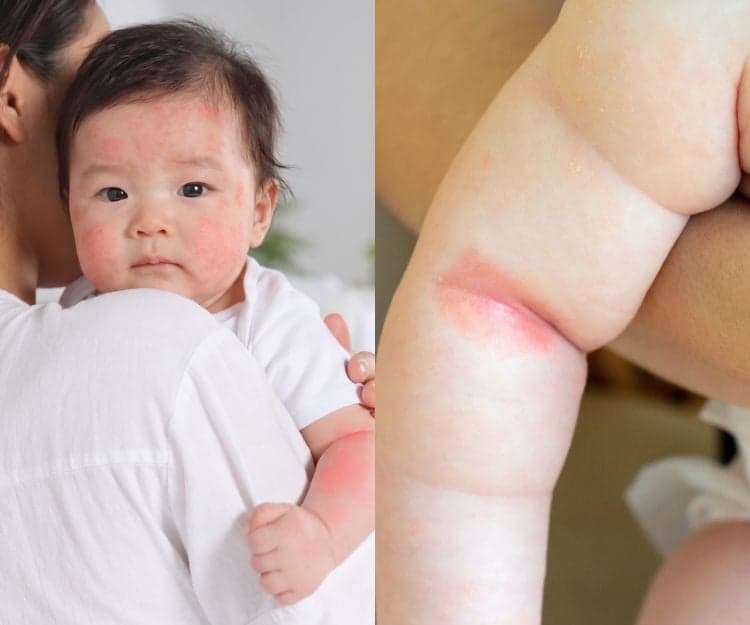BB熱痱大爆發?中醫警告:沖涼做錯1個動作更嚴重!推介「退痱馬蹄湯」+ 30蚊神級外洗方