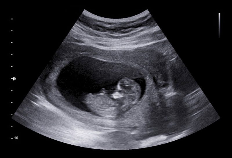 「先兆流產」要小心！中醫教路懷孕首三月注意安胎