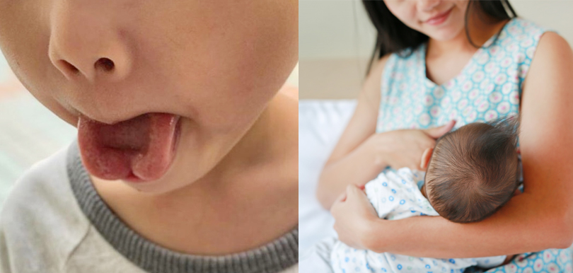 小兒外科顧問醫生：BB食人奶吸力不足、口角漏奶？可能是因為「黐脷筋」！