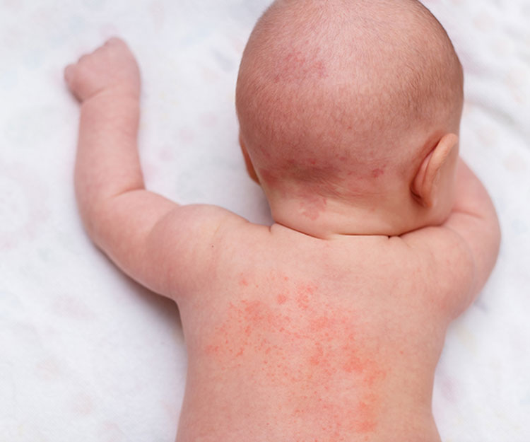 Omicron病癥｜英國臨牀發現15%兒童感染Omicron身上出現皮疹