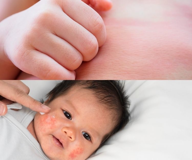 兒童濕疹：中醫籲治療要趁早  免影響睡眠、學習與儀容｜中醫潘子剛