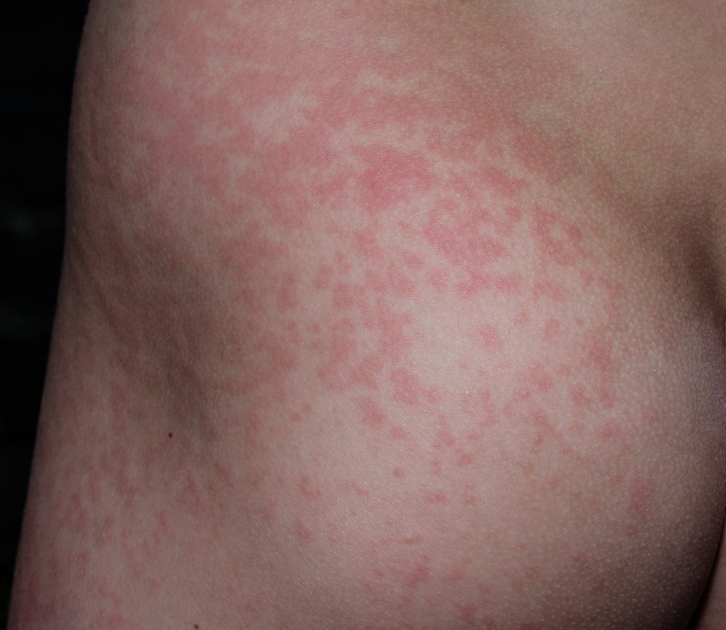 感染第五病的兒童身上出現紅疹。