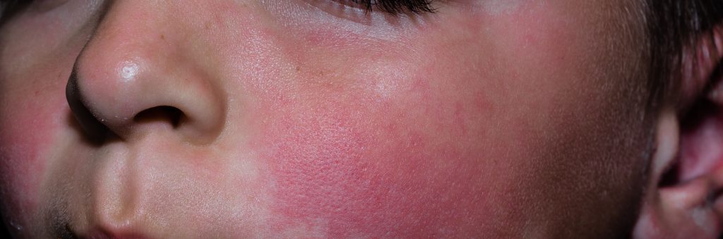 感染第五病的兒童臉上出現紅疹。