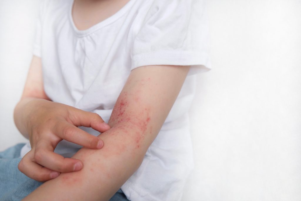 防敏營養-濕疹-幼兒敏感-致敏原