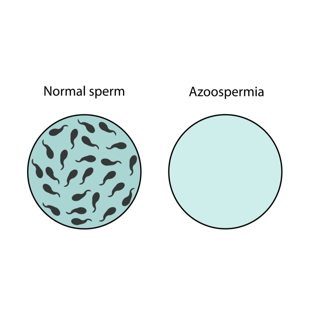 無精症（Azoospermia），是指男性精液中沒有精子的症狀。 