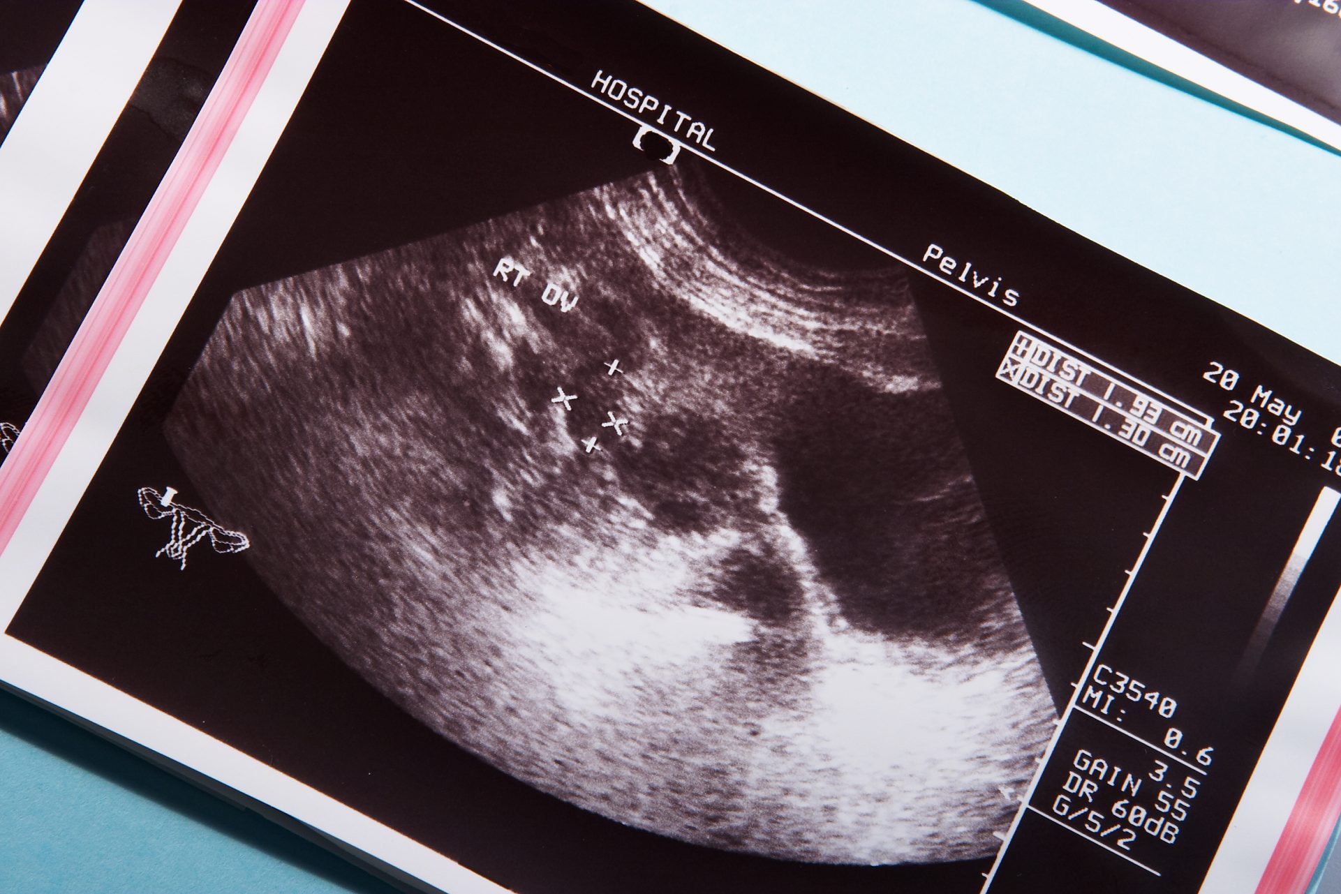 （示意圖）醫生可透過超聲波診斷出婦女是否患有子宮內膜瘜肉。