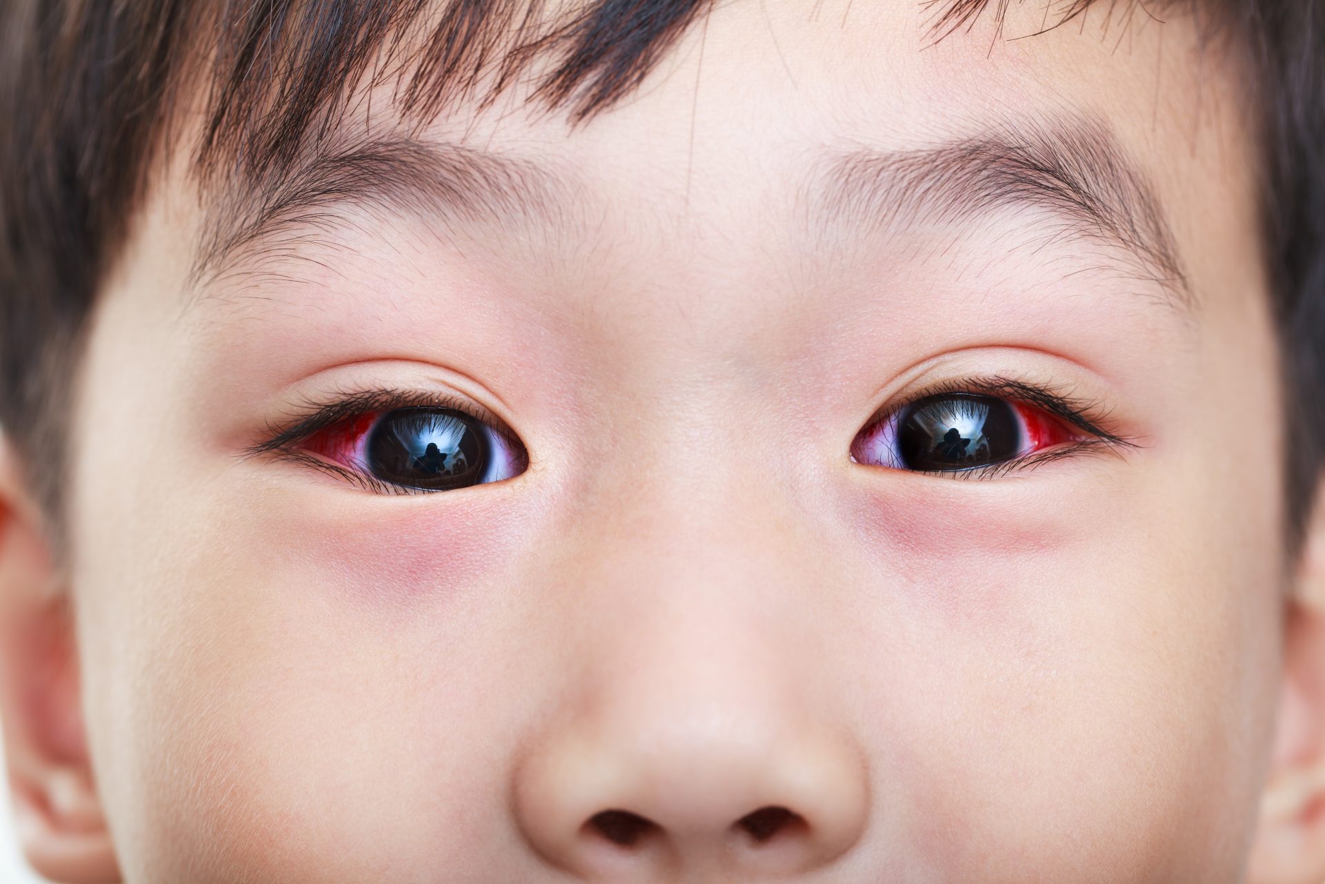 不同血清類型的腺病毒都可引起不同徵狀，部分會令眼睛充血發紅。